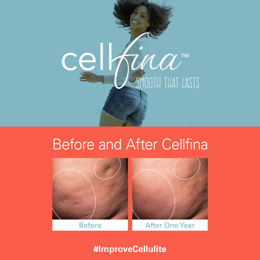 before and after cellfina treatment