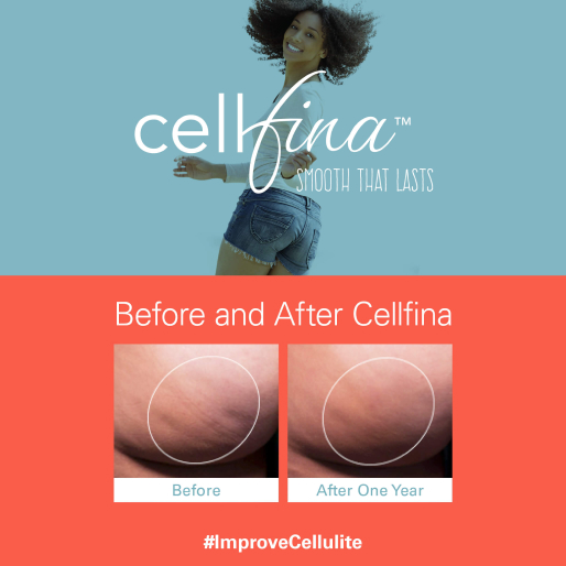 before and after cellfina treatment