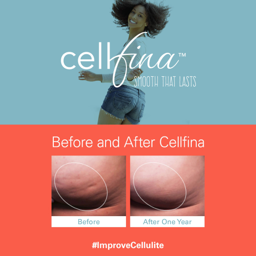 before and after cellfina treatment